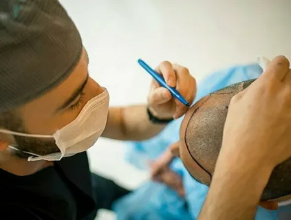 Mistakes to Avoid Before Getting a Hair Transplant