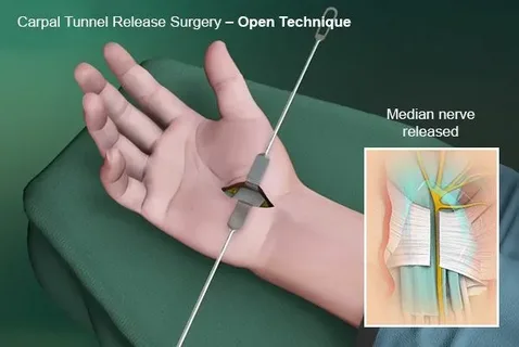 Carpal Tunnel Surgery: When It’s Needed and What Patients Should Expect