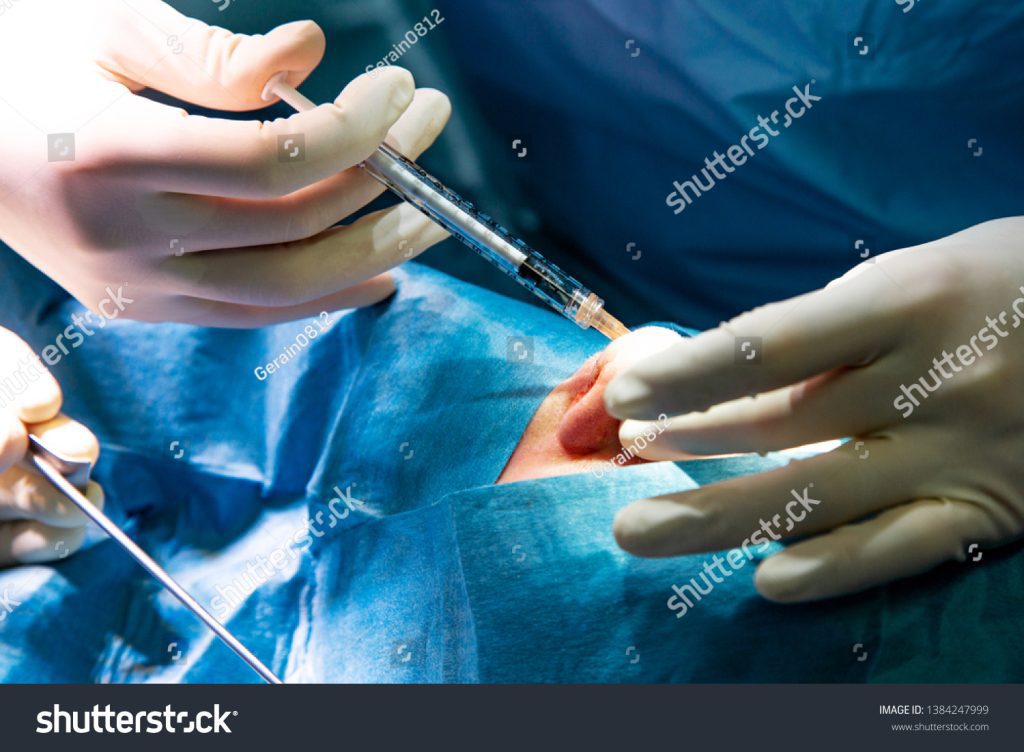 Open vs. Endoscopic Carpal Tunnel Surgery: Which Option Is Right for You?